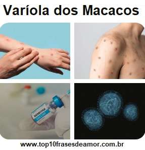 Varíola dos macacos